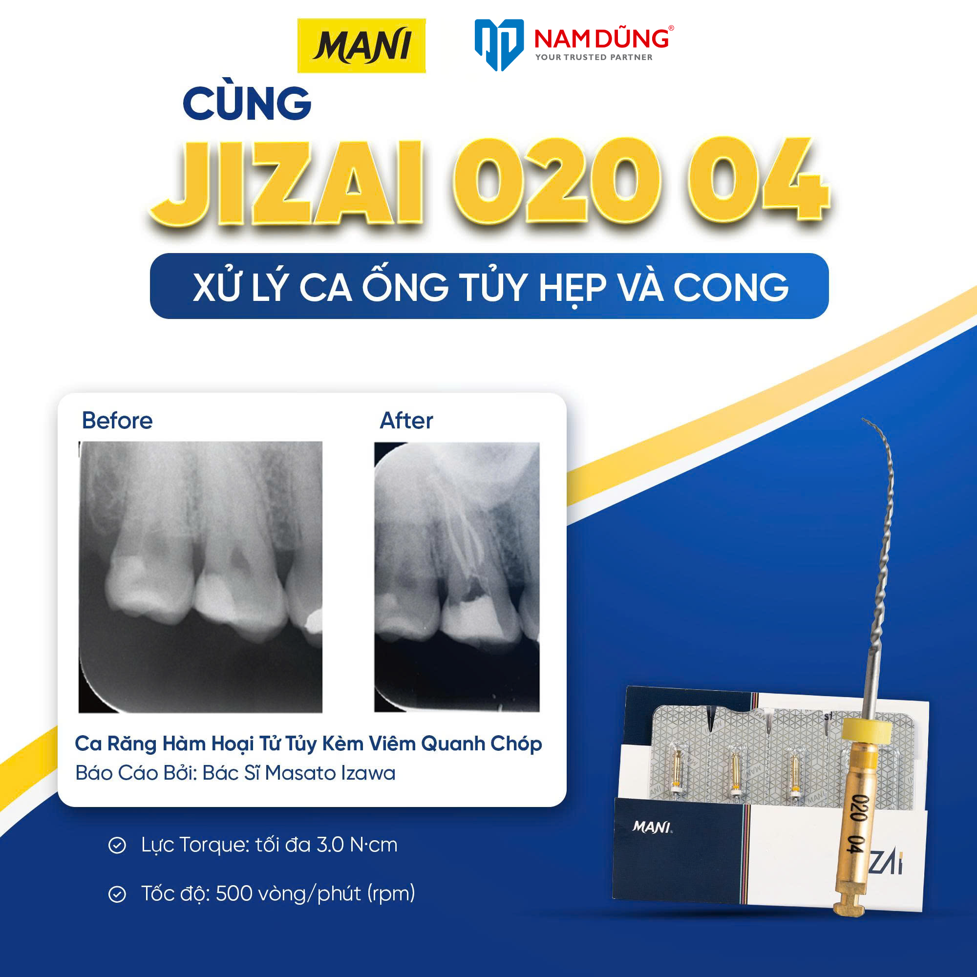 Cùng Jizai 020 04 xử lý ca ống tủy hẹp và cong – Before & After